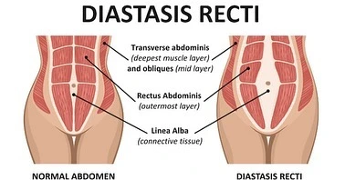 Diastasis Recti Pelvic Floor Strong